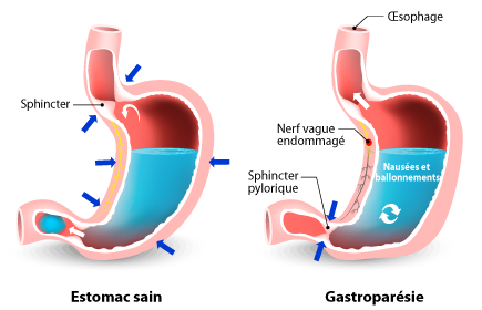 Qu Est Ce Que La Gastropar Sie Et Comment La Chirurgie Bariatrique