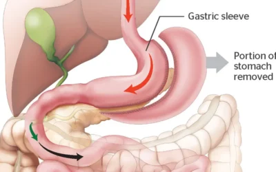 L’évolution de la sleeve gastrique